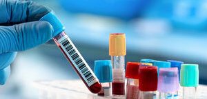 Ebsolute Eosinophil Count